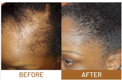 Derma Roller: Skin and Hair Therapy
